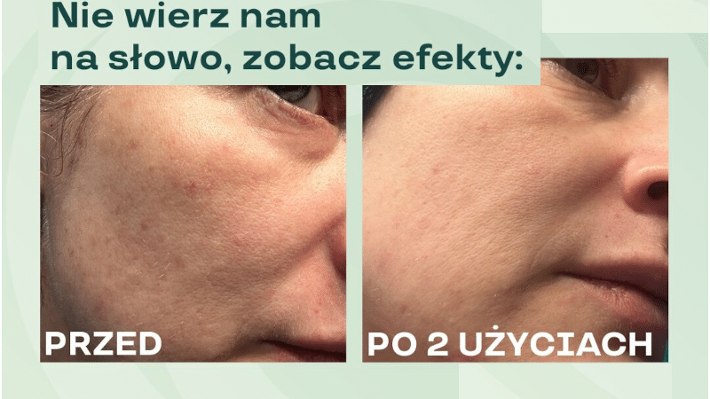 Peeling kwasowy